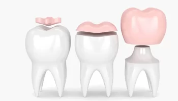 Why Inlays and Onlays Are a Durable Solution for Dental Decay