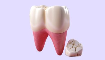 Cracked Tooth or Severe Pain? Why Chester Springs Residents Need an Emergency Dentist Fast